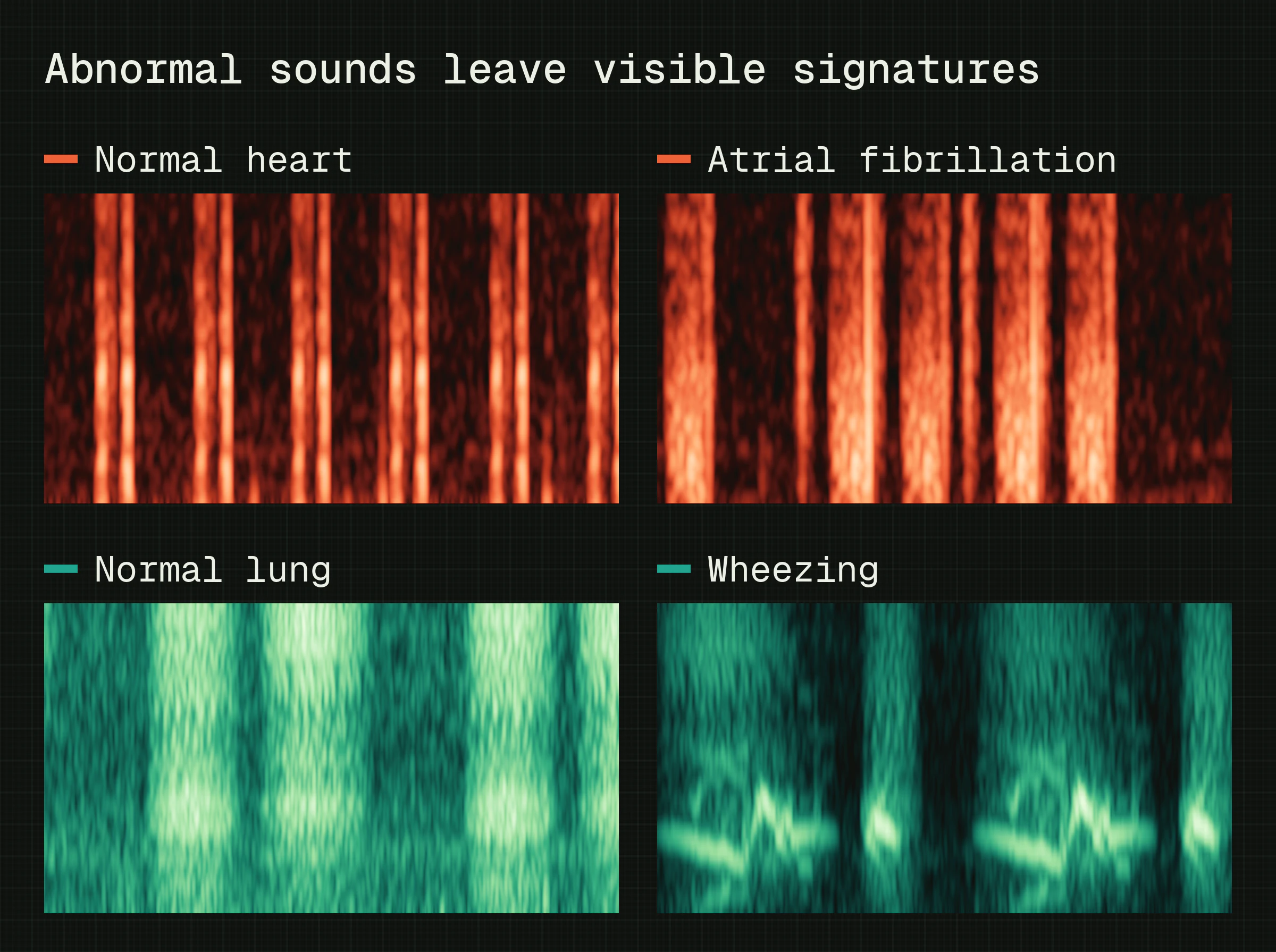 Spectrograms of four real recordings: normal heart and atrial fibrillation, normal lung and wheezing